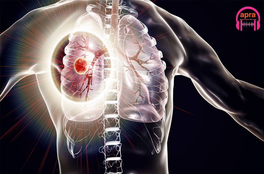 SANTÉ / La tuberculose, première cause de mortalité infectieuse au monde selon l’OMS.