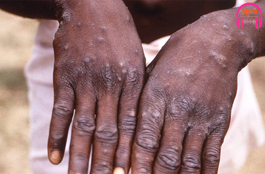 Variole du singe : Les virologues de la CEDEAO se réunissent pour se prémunir de la variole du singe.