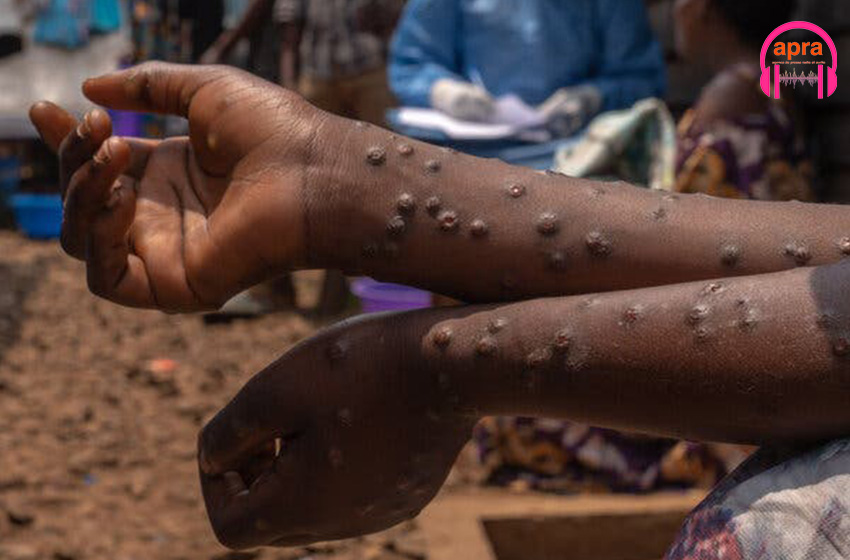 Santé : L'OMS lève l'état d'urgence sanitaire pour la variole en Afrique